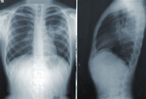 Anterior Posterior And Lateral Chest Radiograph Of Bilateral Hilar