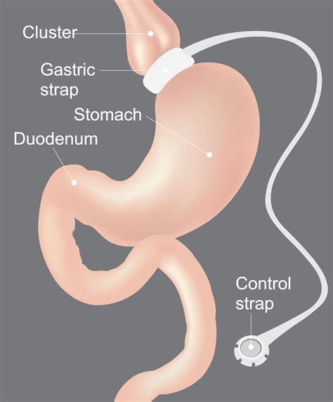 save  gastric band surgery  health travel guide