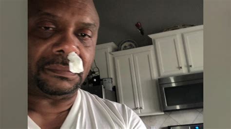 North Carolina Man S Runny Nose Turns Out To Be Leaking Brain Fluid
