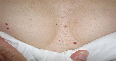 Do You Have Small Bright Red Spots On Skin On Various