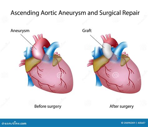 ascending aortic aneurysm stock vector illustration  procedure