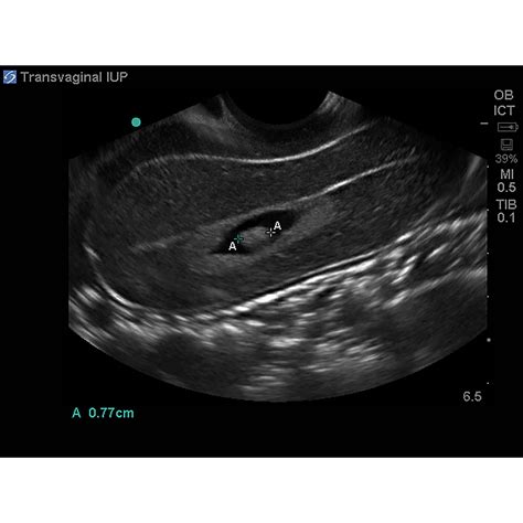 blue phantom ectopic pregnancy transvaginal ultrasound training model  blue phantom