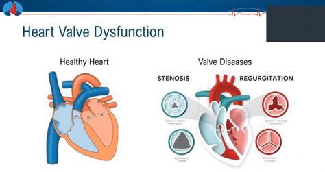 improving  diagnosis  heart valve disease monash institute