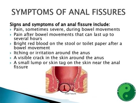 Treatment For Anal Fissure By Dr Tsan Philadelphia Homeopathic Clinic