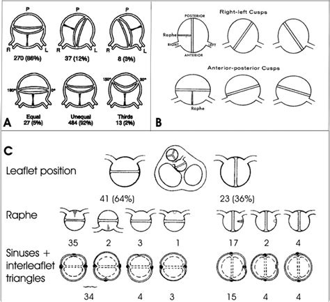 A Classification System For The Bicuspid Aortic Valve From 304 Surgical
