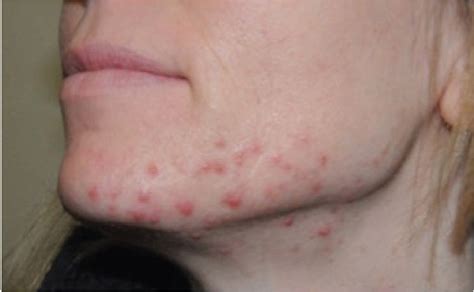 A Clinician’s Guide To Treating Acne