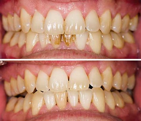 Teeth Cleaning Peace Periodontics Periodontist In