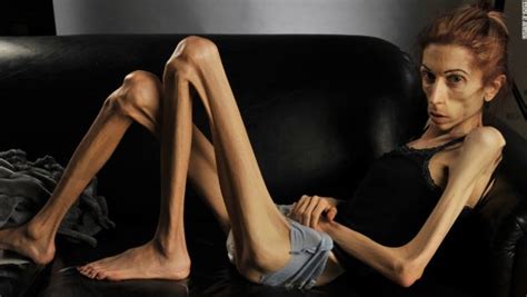 anorexia nervosa eating disorder symptoms causes and treatment of anorexia