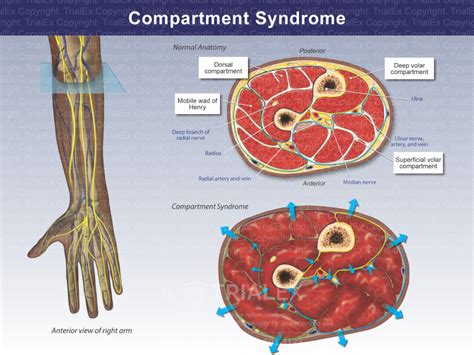compartment syndrome trial exhibits