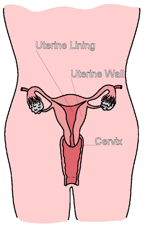 Uterine Fibroids