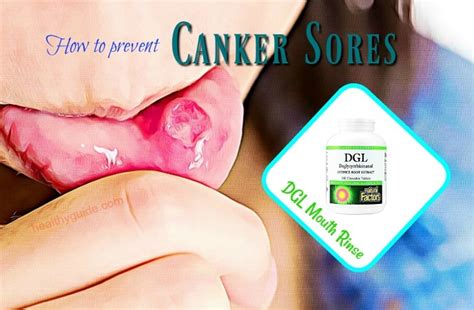 32 Tips How To Prevent Canker Sores On Tongue Lips And In Mouth