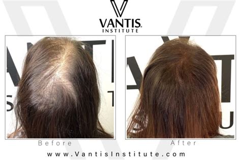 Hair Restoration For Women Female Hair Loss Vantis Institute Vantis