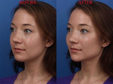 face morphed   plastic surgeon   shocked   results business insider