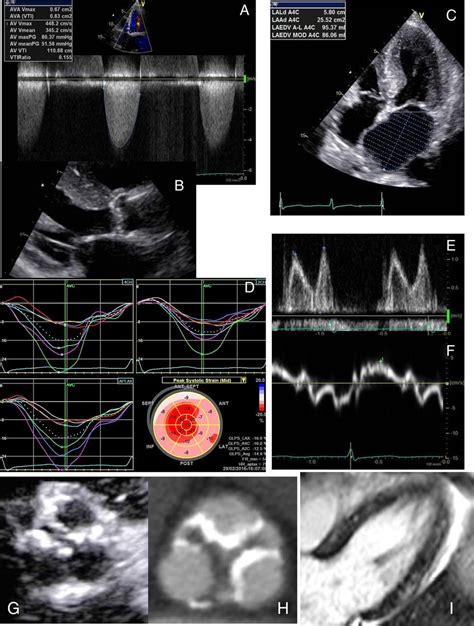 Asymptomatic Severe Aortic Stenosis Challenges In Diagnosis And
