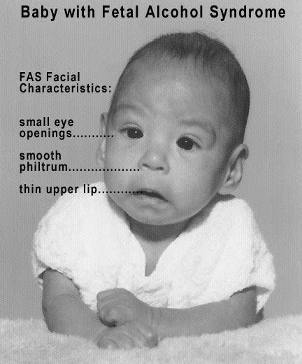 fetal alcohol syndrome pictures facts symptoms causes