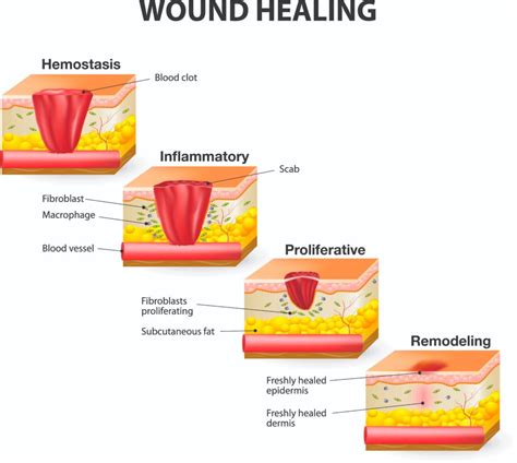 wounds heal  guide   phases  wound healing sanara medtech
