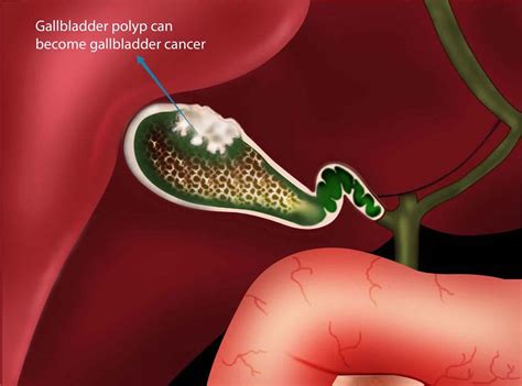gallbladder polyps definition  symptoms diagnosis treatment follow