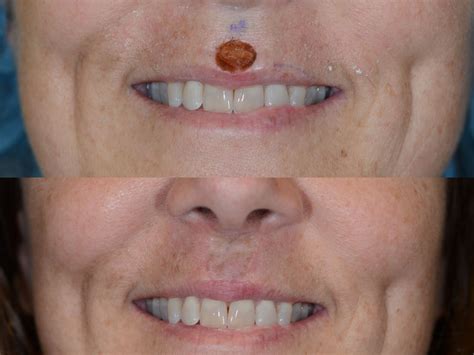 squamous cell  lip reconstructed  mohs surgery