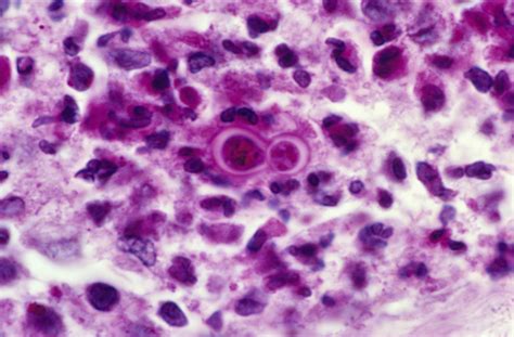 blastomycosis outbreak source  fungal infection cases  wisconsin   mystery huffpost