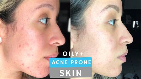 Morning And Night Time Skin Care Routine For Oily Acne