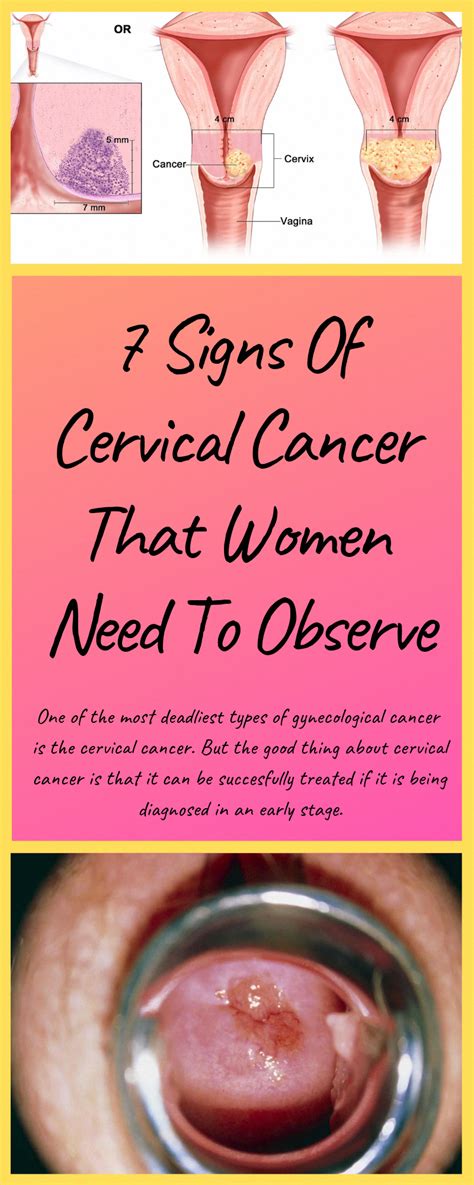 pin on risk of cervical cancer