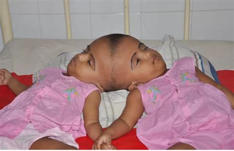 shocking mother cries over birth of conjoined twins photo health