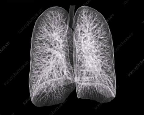 Healthy Lungs Ct Scan Stock Image F011 7598 Science Photo Library