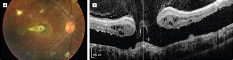 enhanced  cone syndrome  macular hole ophthalmic imaging jama
