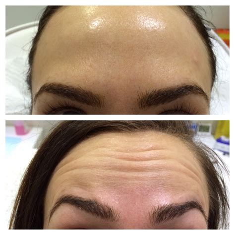 forehead frownlines true  skin clinics