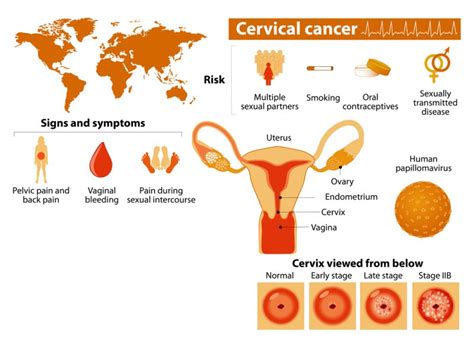 women    early signs  cervical cancer david avocado