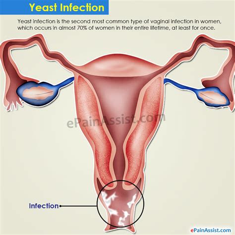 Sex And Yeast Infection Treatment Sex And Yeast Infection