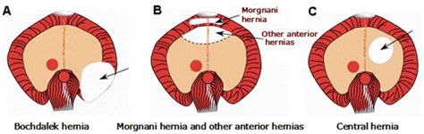 diaphragmatic hernia  symptoms diagnosis treatment prognosis