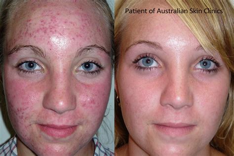 tips treatment  acne acne scars australian skin clinics