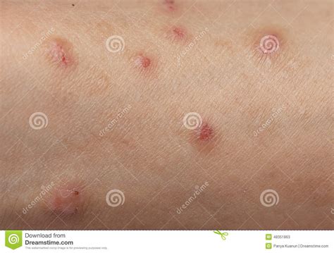 Tipos De Alergias De Pele Com Fotos
