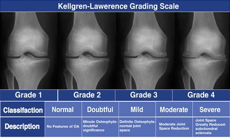 guide  severe knee arthritis osteoarthritis spring loaded technology