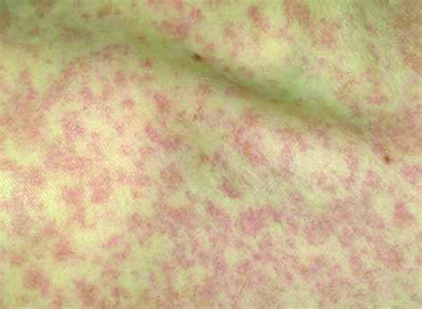 meningitis rash pictures