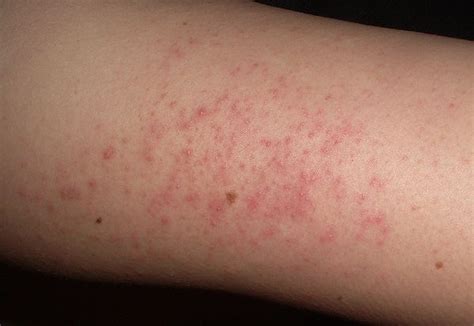 pimples  arms  treatment home care pictures diseases