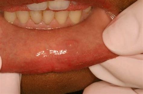 mucous cyst  lip siteliporg