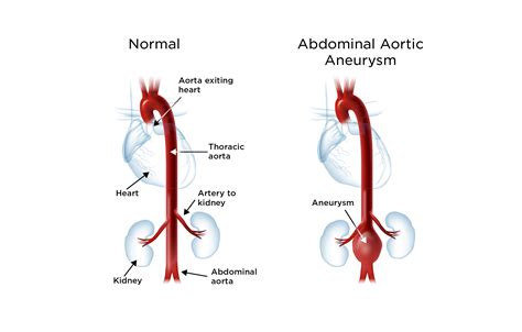 abdominal aortic aneurysm op pain vrogueco