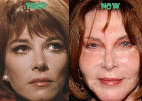 Lee Grant Awful Plastic Surgery Before And After Pictures