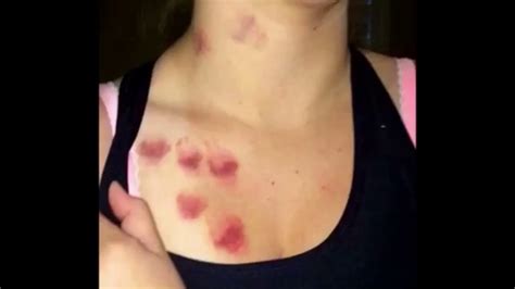 love bites on neck and chest