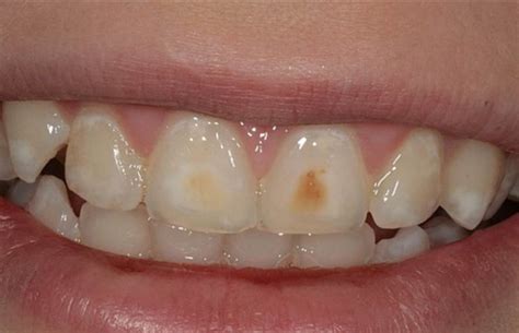 difference  cavities  stains key differences