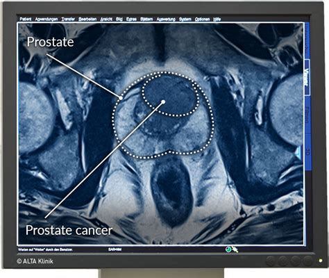 Multiparametric Mri Of The Prostate Alta Klinik