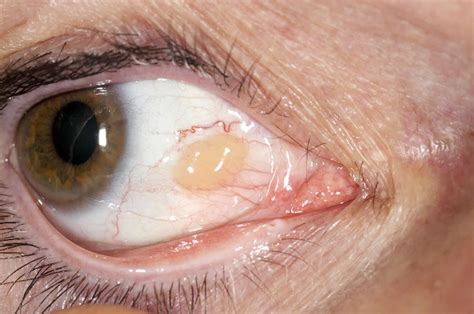 pinguecula eye  symptoms diagnosis pinguecula eye treatment