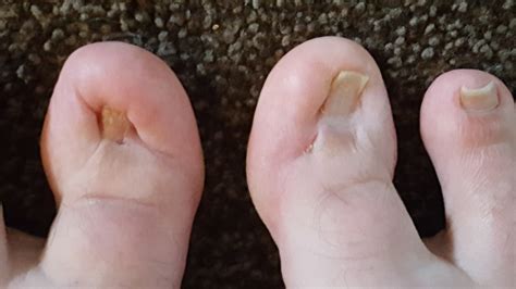 ingrown toenail living   ugliest toes   world