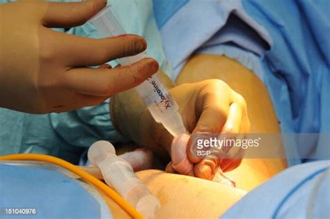vaginoplasty pictures getty images
