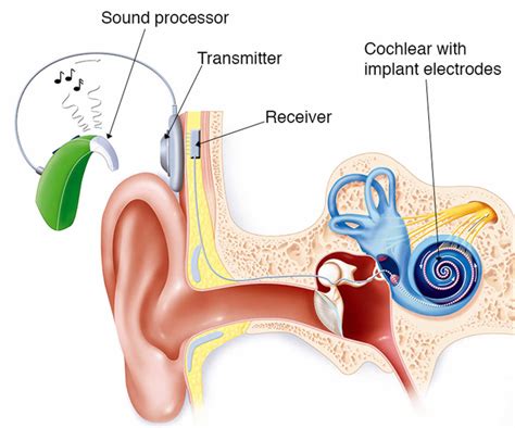 cochlear implant function surgery  cochlear implant pros  cons