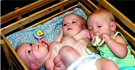 this unusual set of conjoined twins was born but take a look at them