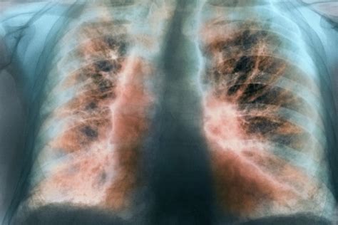 diagnosis  management  idiopathic pulmonary fibrosis