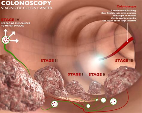 colon polyps